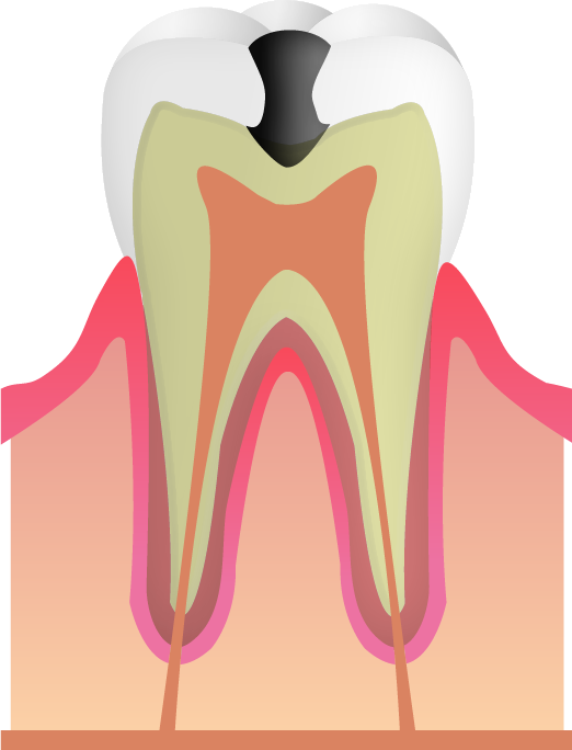 大きなむし歯の場合