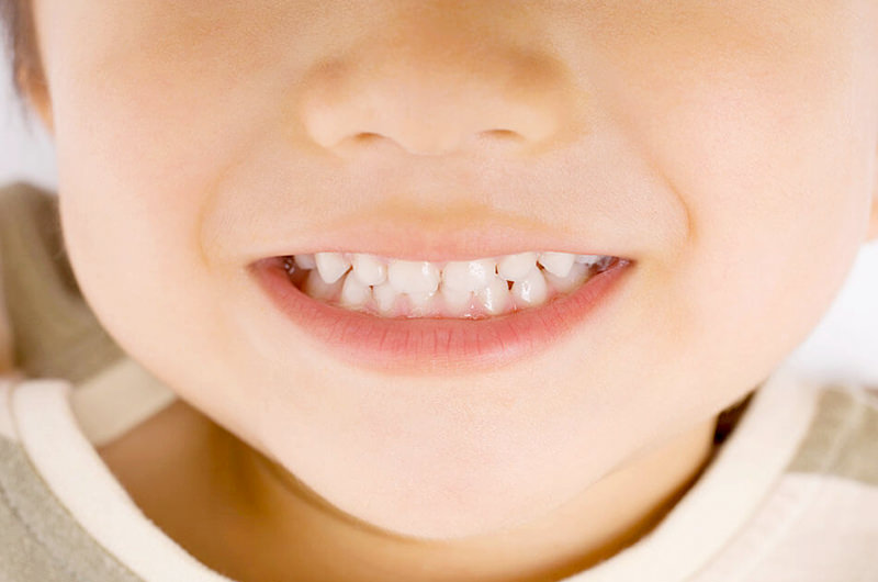 乳歯のむし歯の永久歯への悪影響